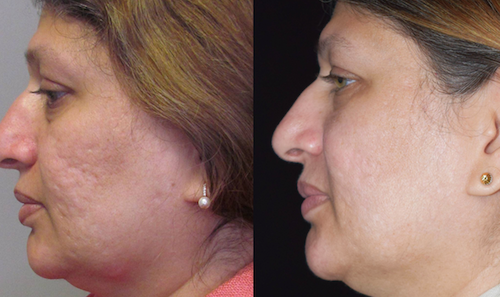 facial acne scarring before after mississauga oakville